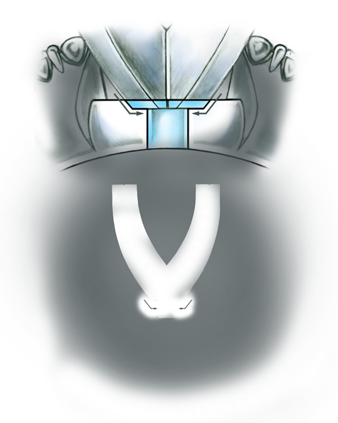 Evaluate the quality of a platinum ring mounting after its peg setting is replaced with another using these helpful illustrations and instructional video