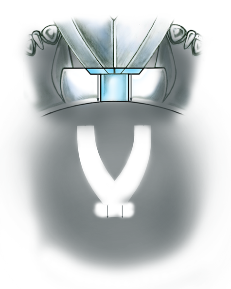 Evaluate the quality of a platinum ring mounting after its peg setting is replaced with another using these helpful illustrations and instructional video