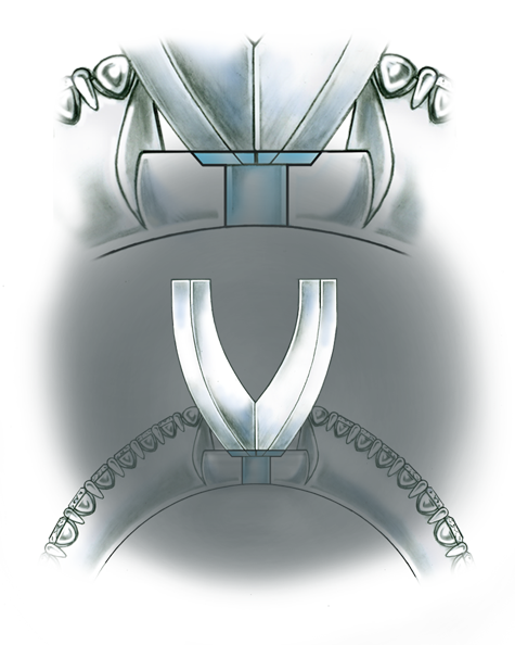 Evaluate the quality of a platinum ring mounting after its peg setting is replaced with another using these helpful illustrations and instructional video