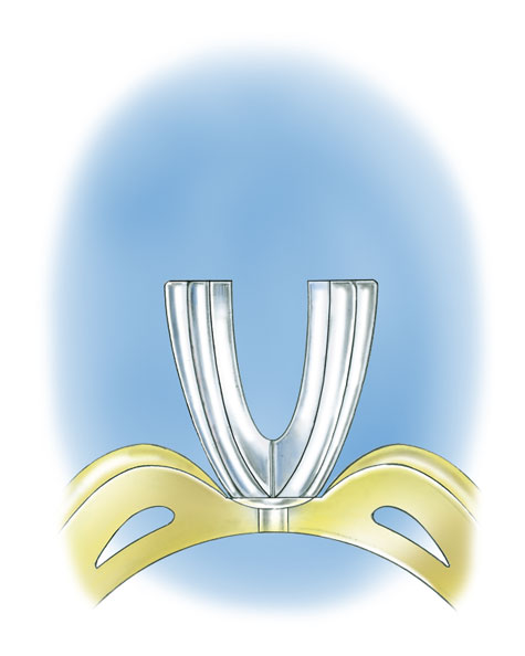 Close-up side view illustration of a platinum peg setting in a yellow gold mounting; the bottom of the peg is visible through the yellow gold