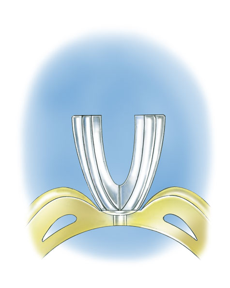 Learn how to evaluate the quality of a platinum ruthenium peg setting installation into a 14K yellow gold mounting with these helpful illustrations and instructional video