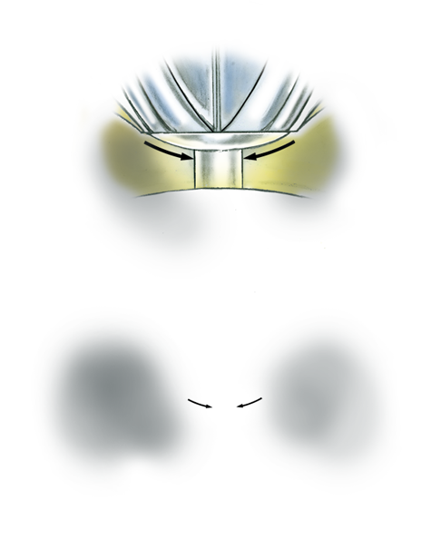 Learn how to evaluate the quality of a platinum ruthenium peg setting installation into a 14K yellow gold mounting with these helpful illustrations and instructional video