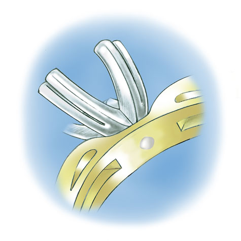 Close-up illustration of the underside of a platinum peg setting in a yellow gold mounting; the bottom of the peg is visible 