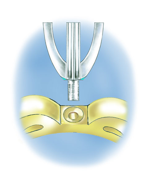 Close-up side view illustration of a platinum peg setting prior to being soldered to the yellow gold mounting