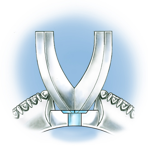 Peg, Setting, Replacement, Installation, platinum, cobalt, ring, jewelry, diamonds, quality, assurance, benchmark, QAB