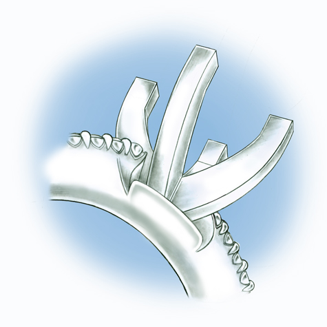 Illustration showing the cross-section of a platinum solitaire with diamonds set in the shank where the peg setting is visible