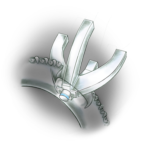 Evaluate the quality of a platinum ring mounting after its peg setting is replaced with another using these helpful illustrations and instructional video